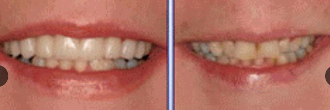 نتائج لاشخاص قبل وبعد تبييض الأسنان بالليزر