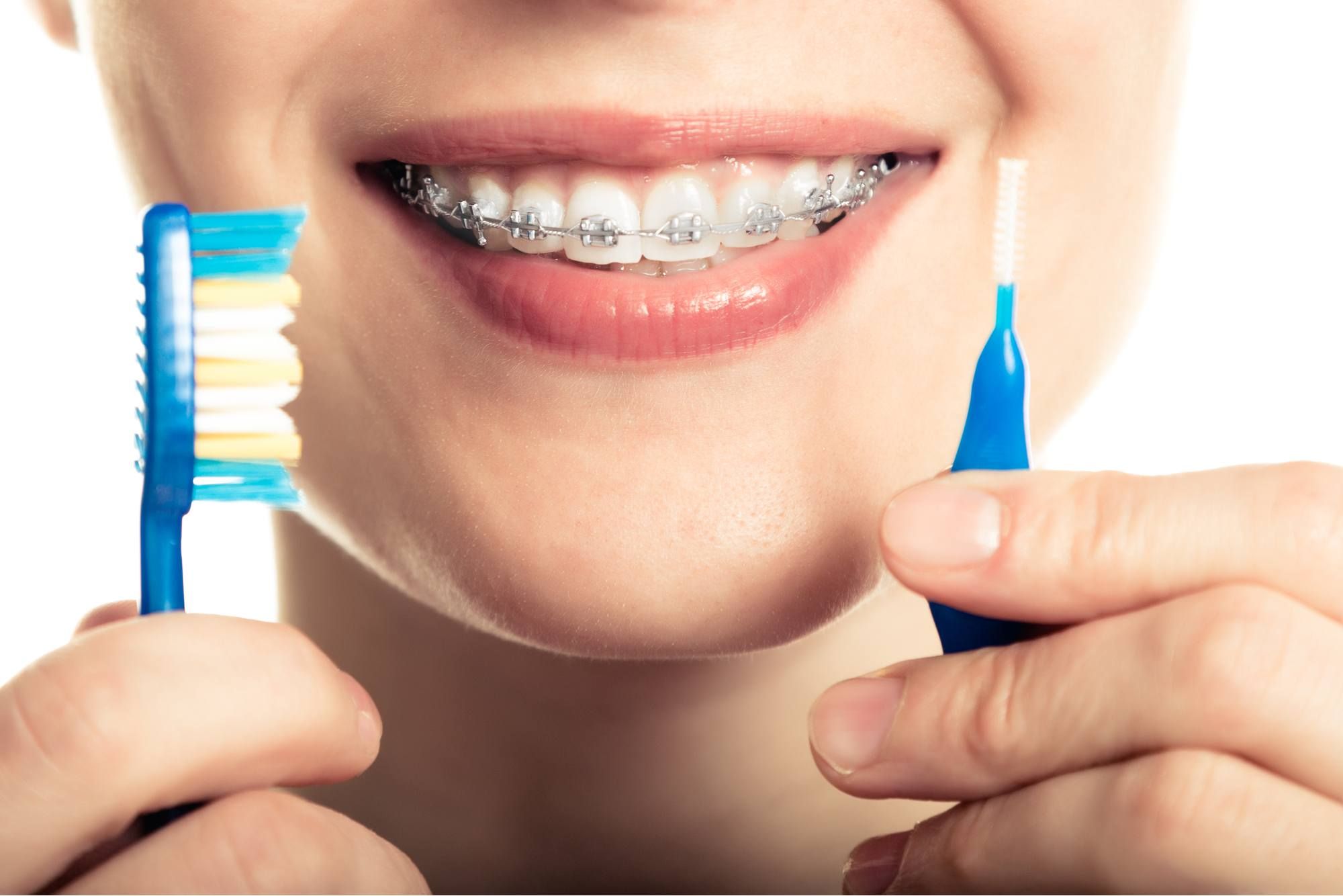 ⁨‎⁨كيفية العناية بالأسنان أثناء فترة التقويم⁩⁩