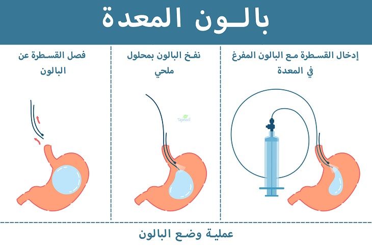 ⁨‎⁨بالون المعدة⁩⁩