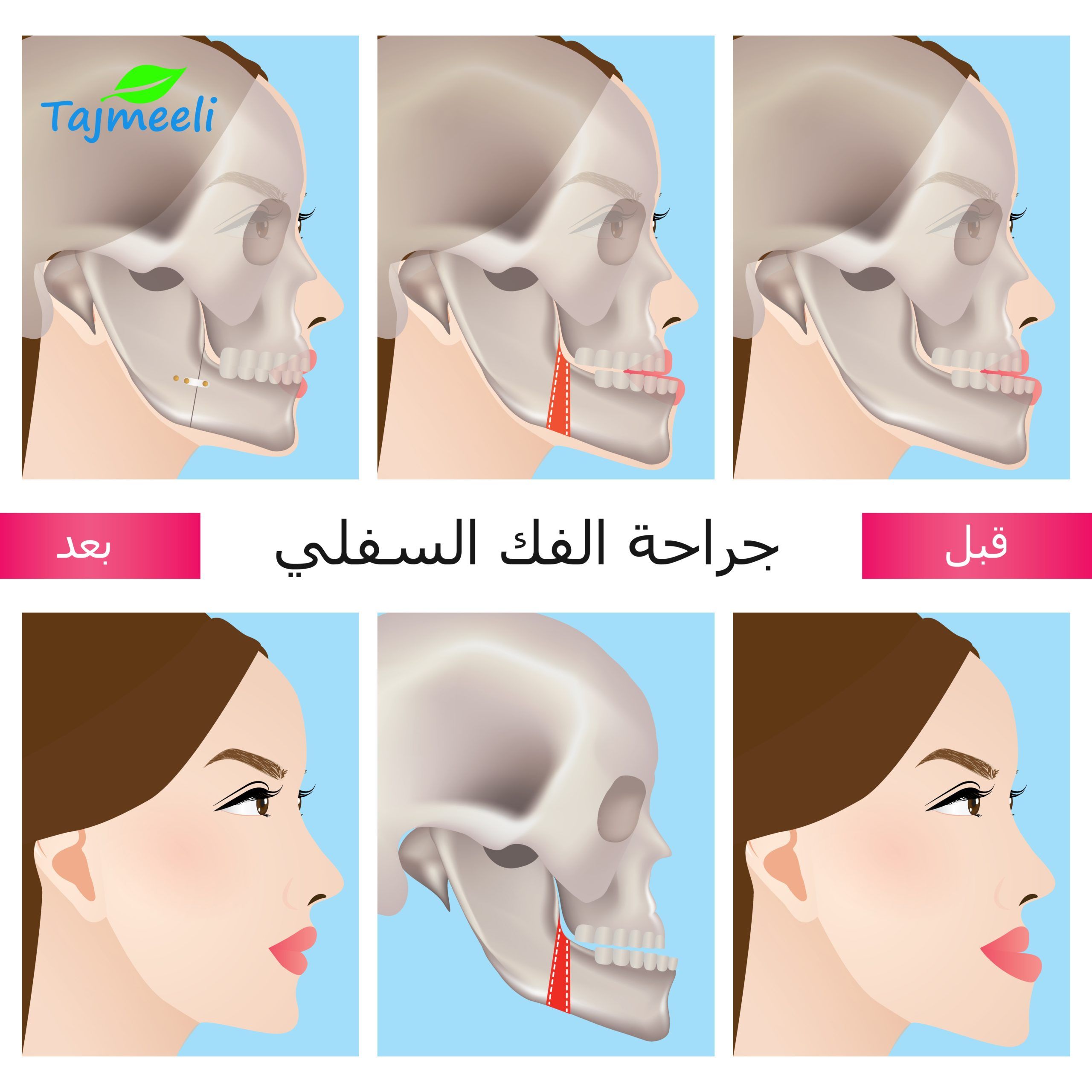 جراحة تعريض الفك قبل و بعد