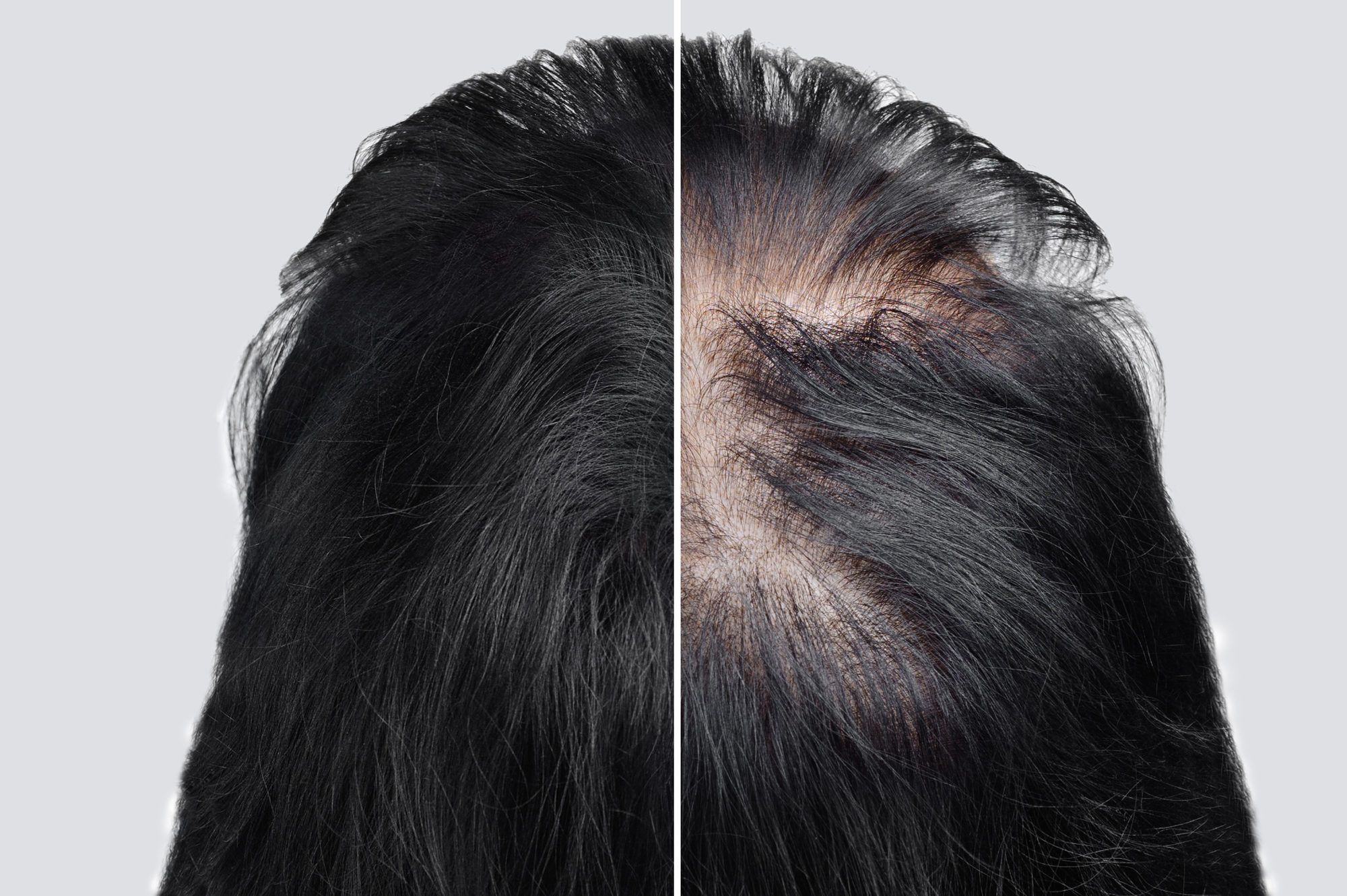 ⁨‎⁨زراعة الشعر ⁩⁩