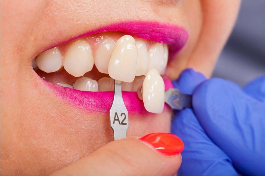 تعديل الاسنان بالفينير 