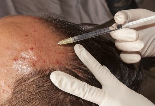 تأثير حقن البلازما على نتائج عملية زرع الشعر