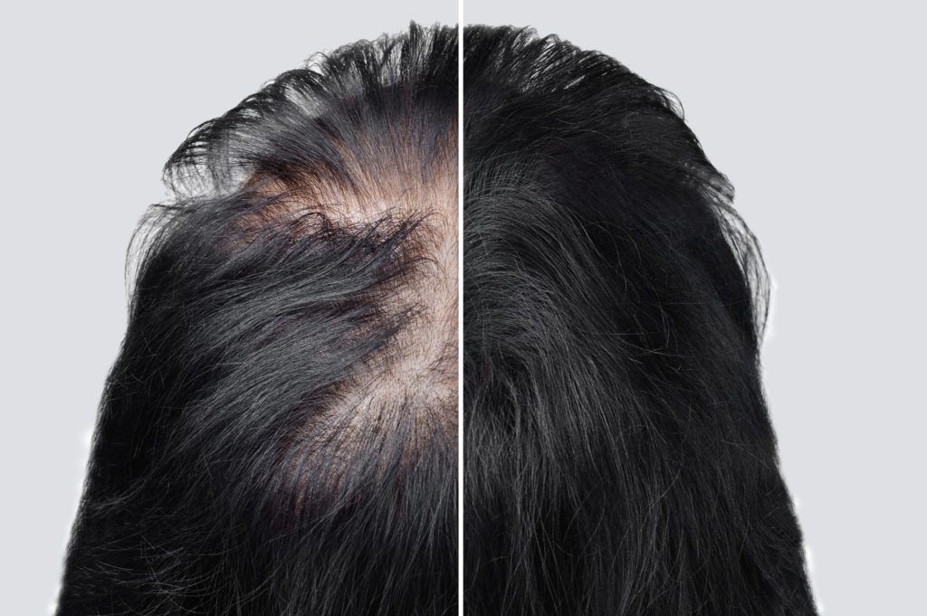 متى تظهر نتائج عملية زراعة الشعر النهائية؟