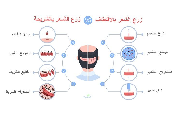 زرع الشعر بالاقتطاف vs زرع الشعر بالشريحة