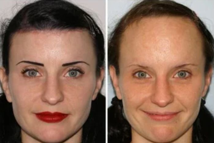نتائج قبل وبعد علاج الصلع عند النساء