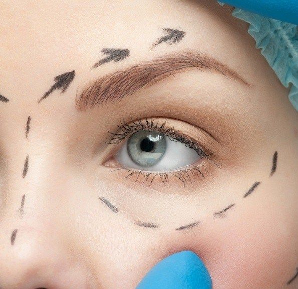 جراحة الجفن التجميلية