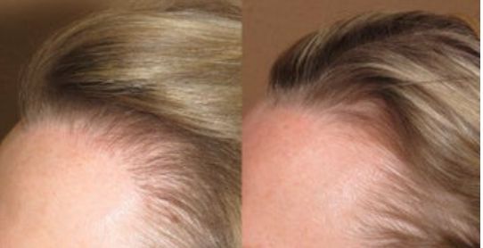 صور لتجارب أشخاص قاموا باجراء عملية زراعة الشعر قبل وبعد 