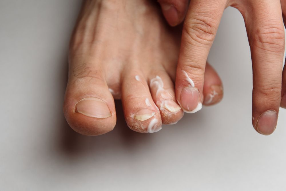 علاج تشقق الجلد حول أظافر القدمين