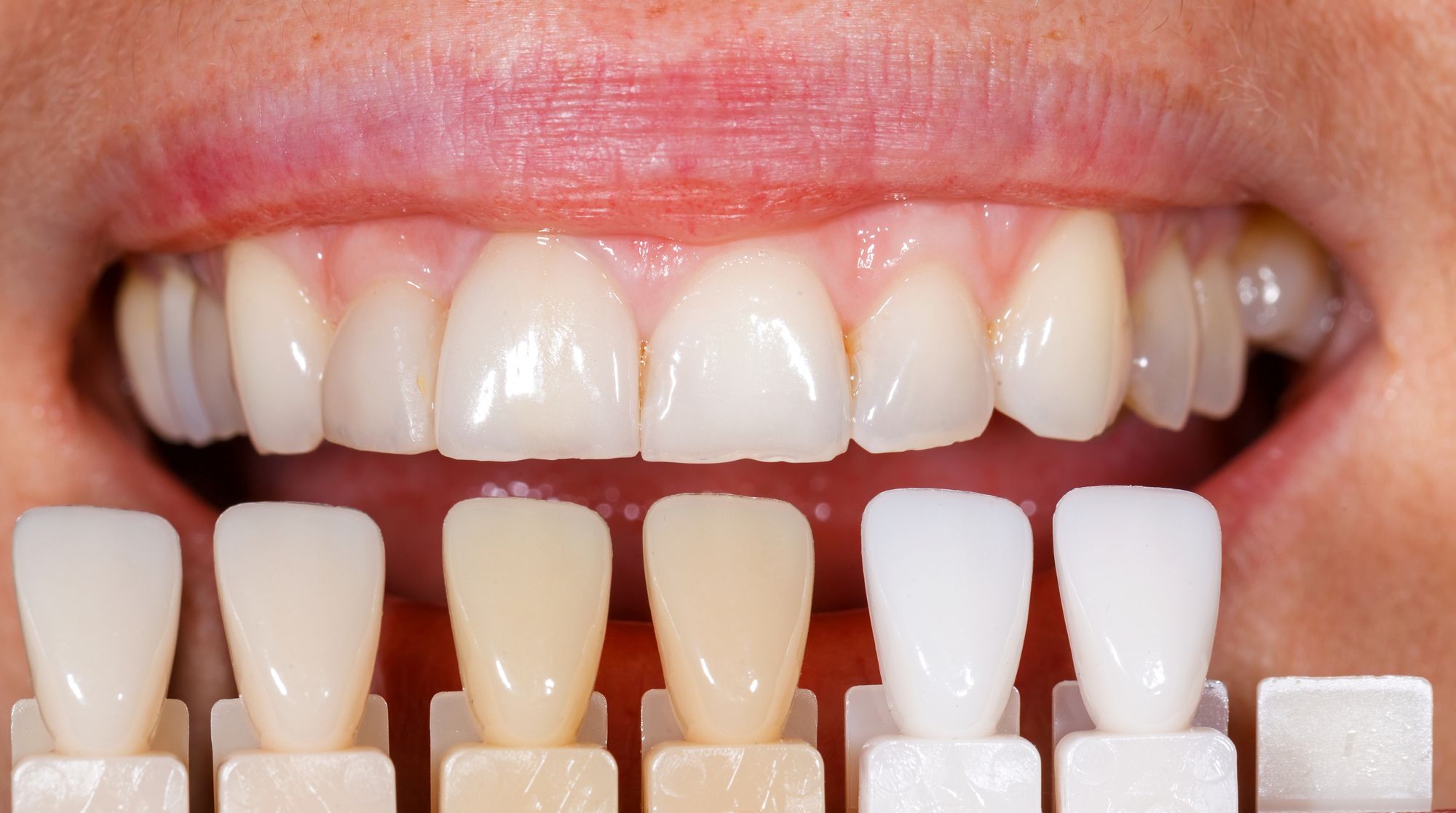 معايير اختيار لون تقويم الأسنان