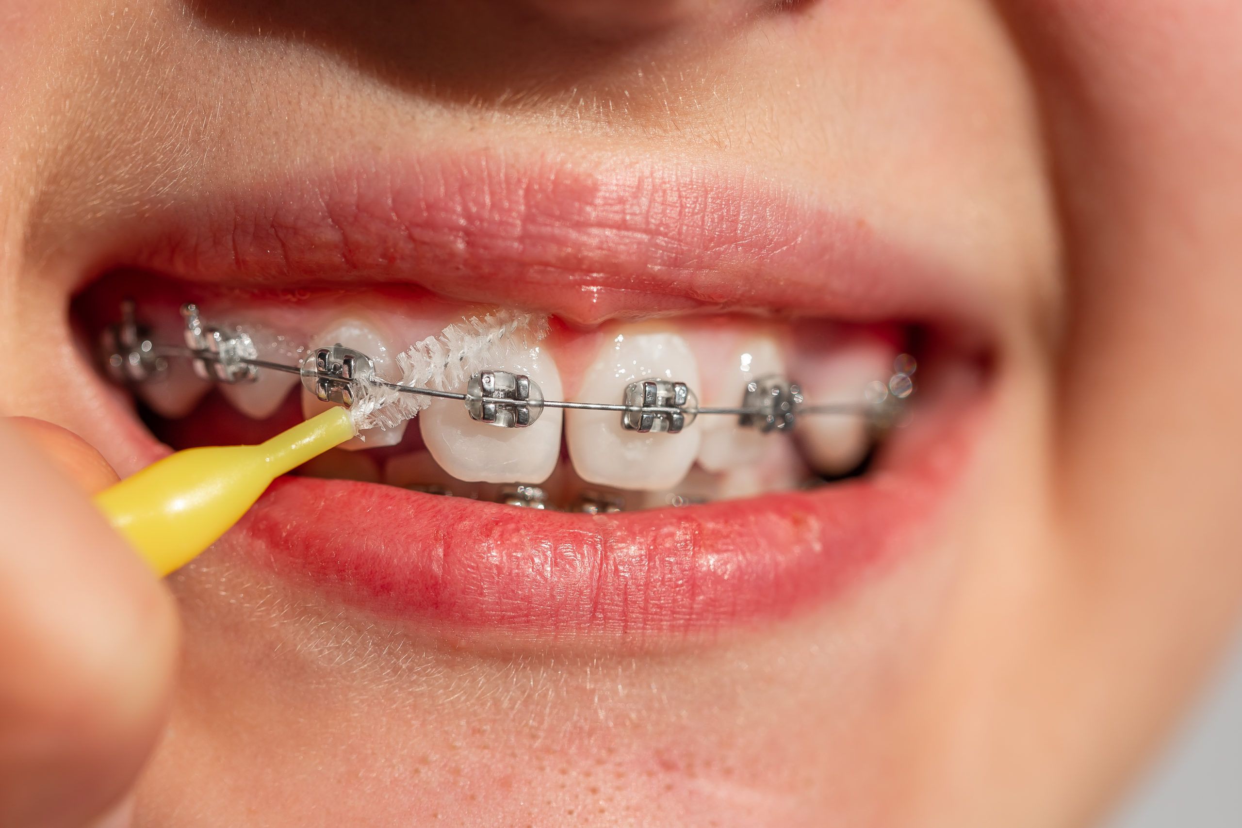 كيف يمكننا المحافظة على تقويم الأسنان؟