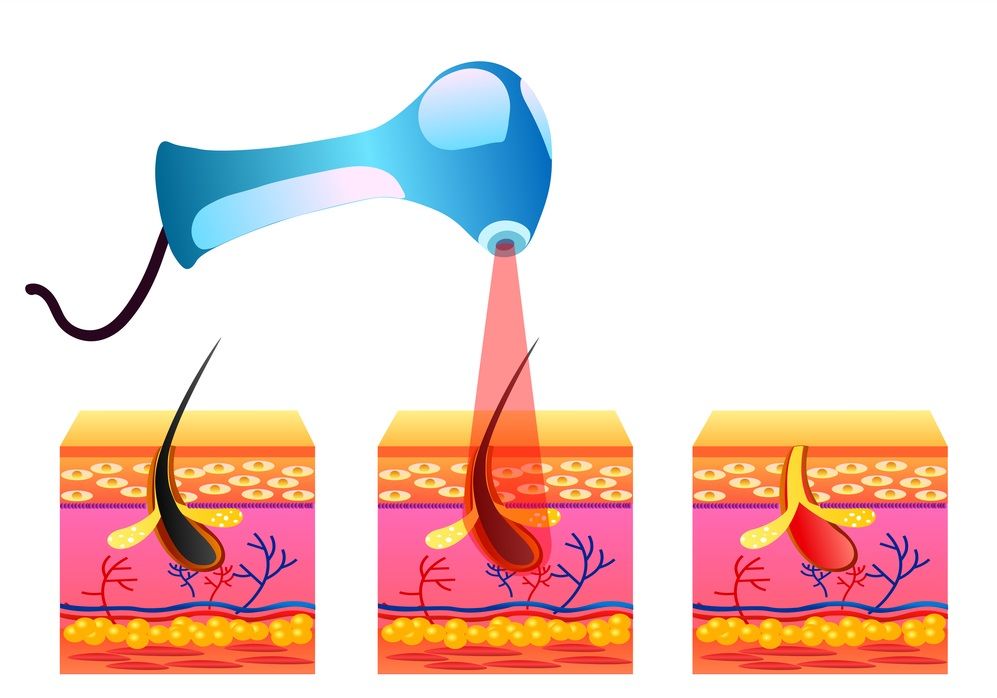  كيف يستخدم الليزر في إزالة الشعر؟