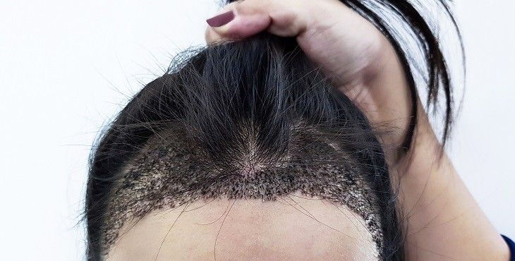 ترشيحات بأفضل أطباء زراعة الشعر بدون حلاقة في مصر