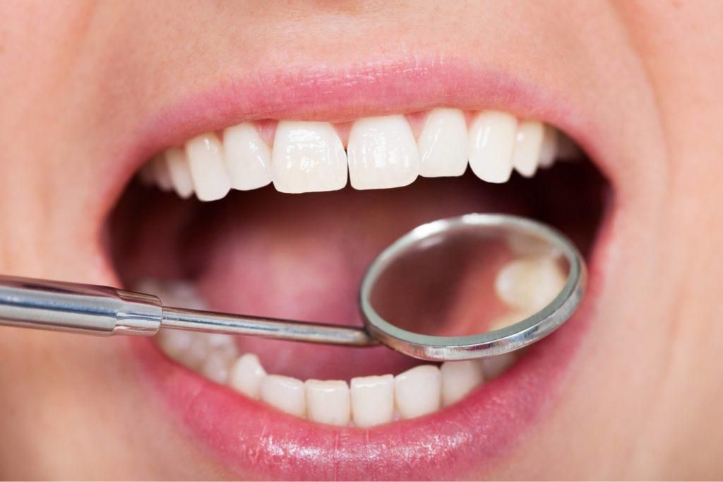 عملية تلبيس الاسنان الامامية