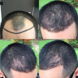 تجربة زراعة الشعر بتقنية الاقتطاف