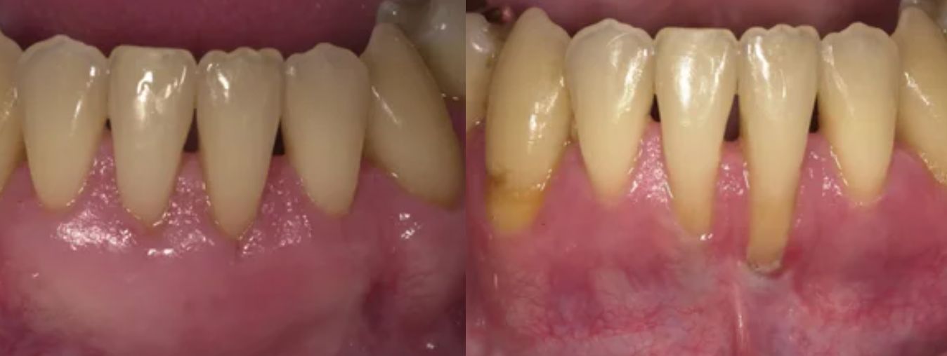تجربة علاج انحسار اللثة