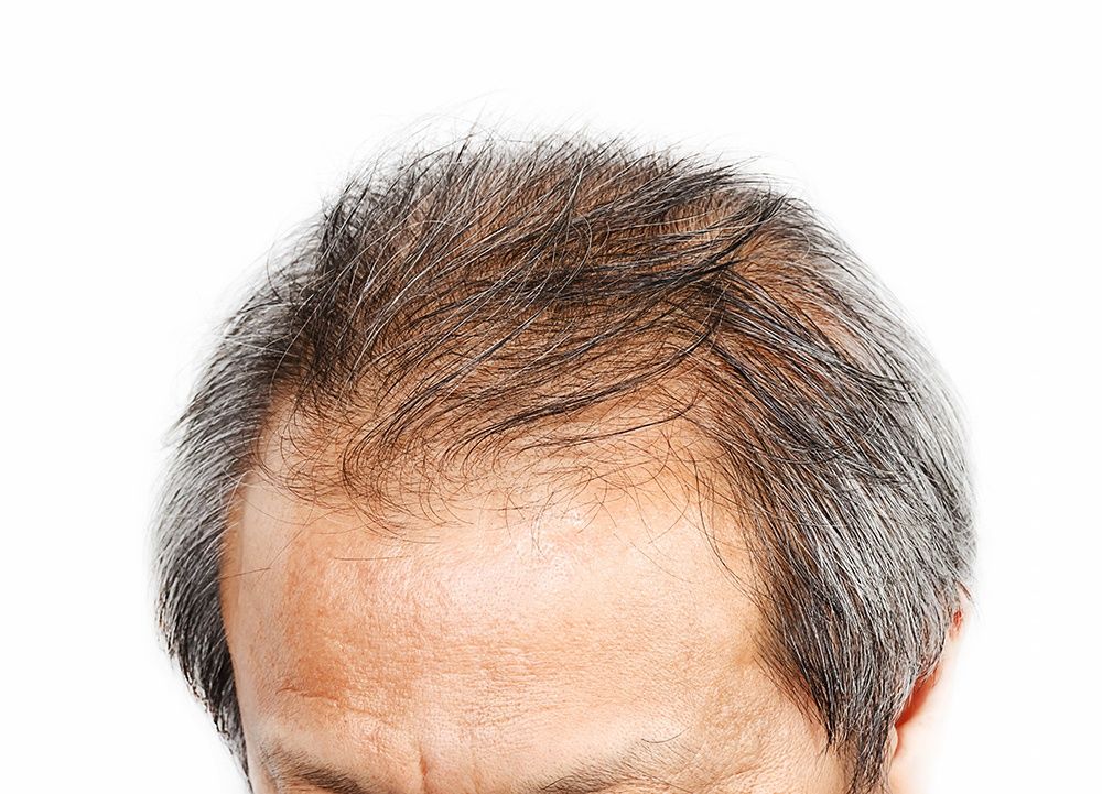 Male Head with Hair Loss