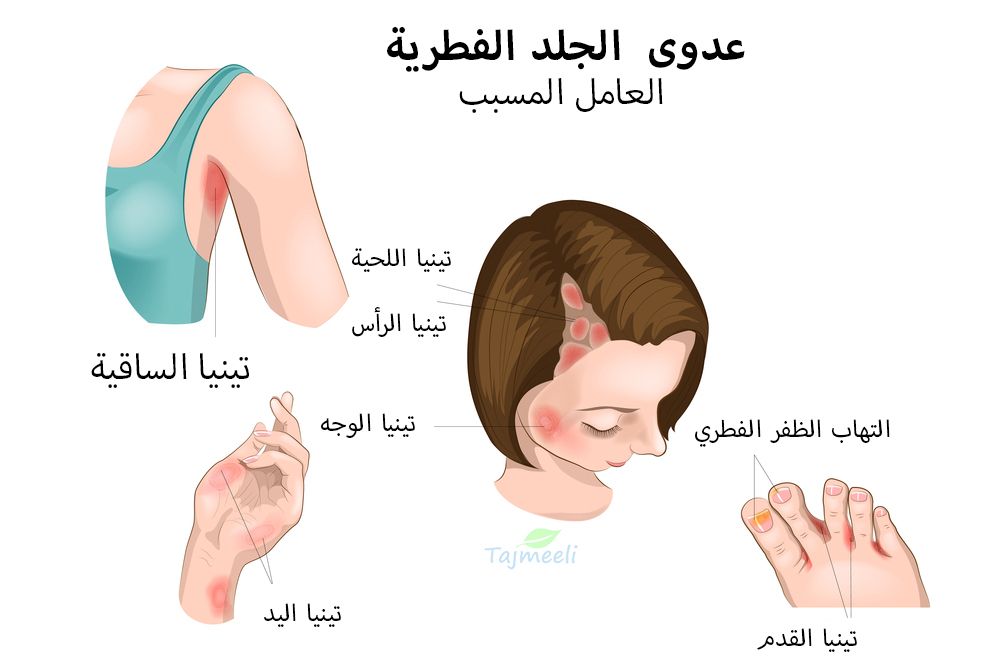 ⁨‎⁨اسباب التينيا⁩⁩