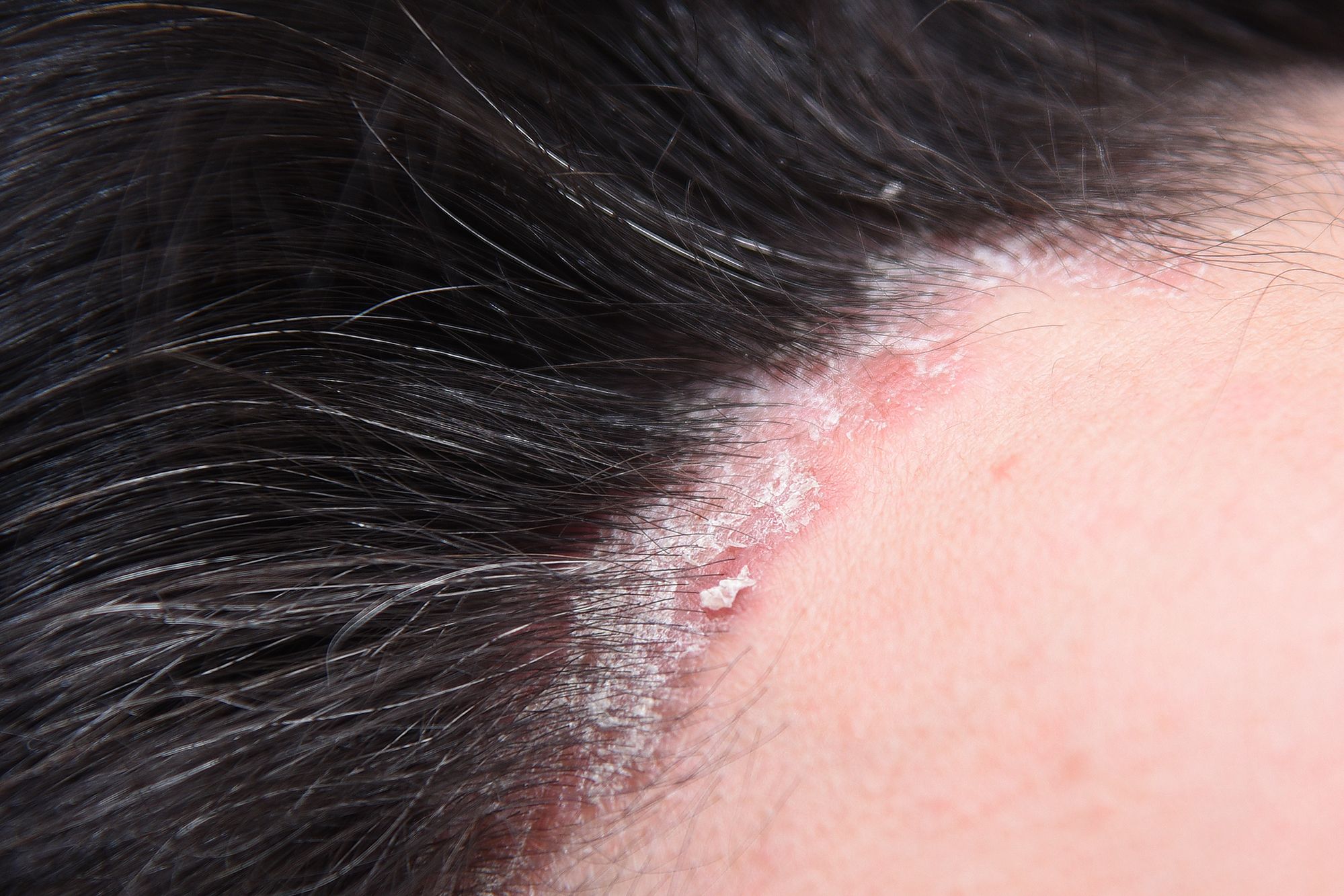 يفيد زيت الارغان في علاج حالات اكزيما الشعر