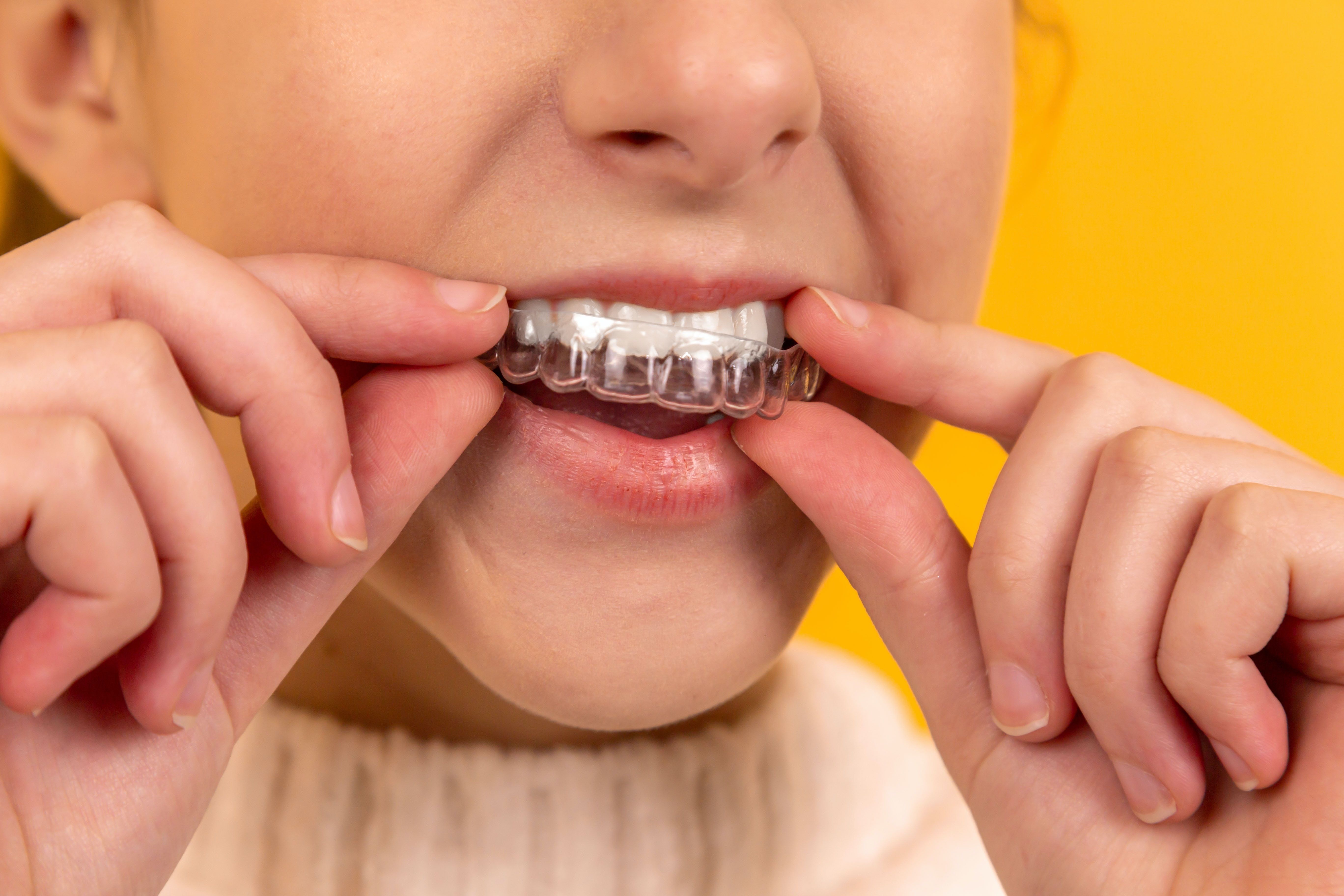 أنواع تقويم الاسنان للاطفال