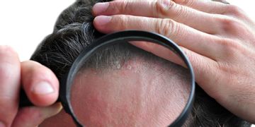 هل يتساقط الشعر بسبب الإكزيما؟