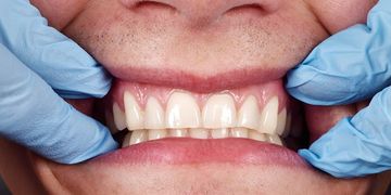 أسباب وعلاج نزول اللثة وتعري الأسنان