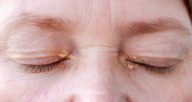 ازالة الزوائد الجلدية حول العين