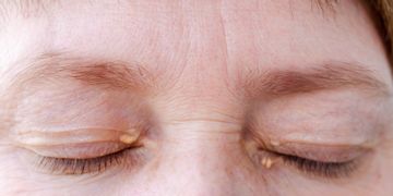 ازالة الزوائد الجلدية حول العين