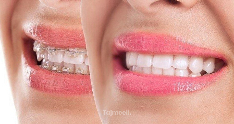 اضرار تقويم الاسنان