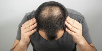 الفرق بين بروبيشيا وبروسكار لعلاج تساقط الشعر