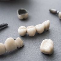 الفرق بين تركيب الأسنان وزراعة الأسنان