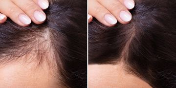 تجربتي مع زراعة الشعر بالاقتطاف