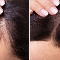 تجربتي مع زراعة الشعر بالاقتطاف