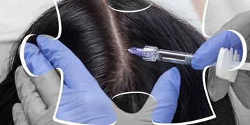 تجربتي مع زراعة الشعر للنساء