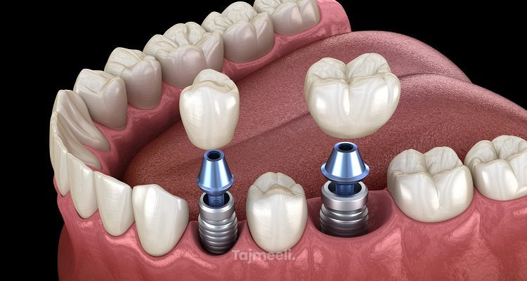 تركيب الأسنان الثابتة