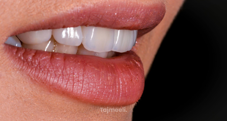 تعديل الأسنان الأمامية