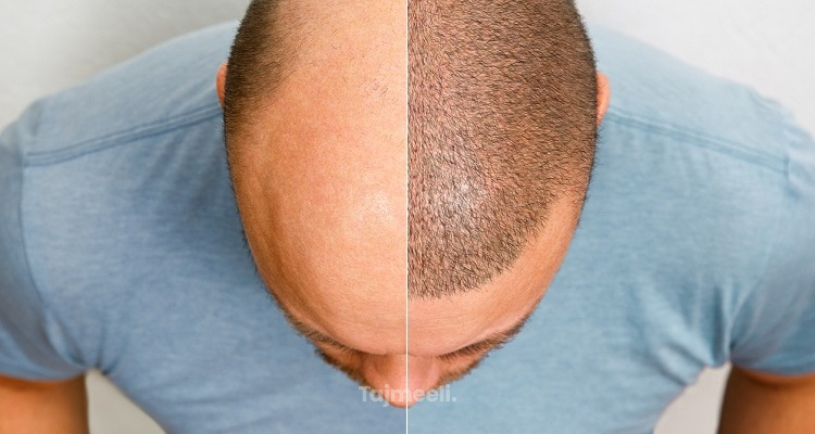 زراعة الشعر بالاقتطاف