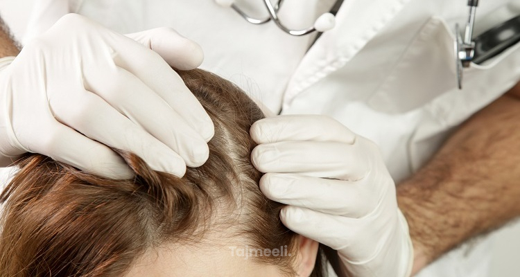 زراعة الشعر بالخلايا الجذعية