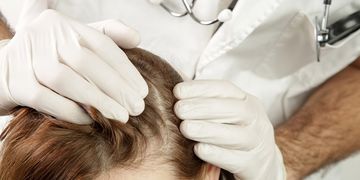 زراعة الشعر بالخلايا الجذعية