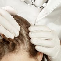 زراعة الشعر بالخلايا الجذعية