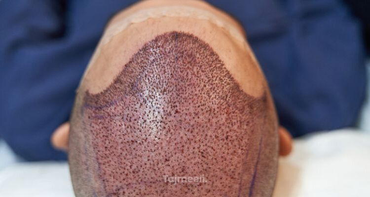 زراعة الشعر بتقنية الخلايا الجذعية