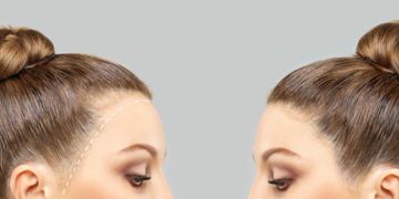 زراعة الشعر قبل وبعد للنساء