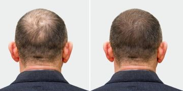 زراعة الشعر قبل وبعد