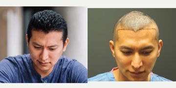 صور قبل وبعد زراعة الشعر الطبيعي