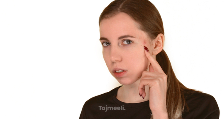 طرق علاج الكيس الدهني في الوجه