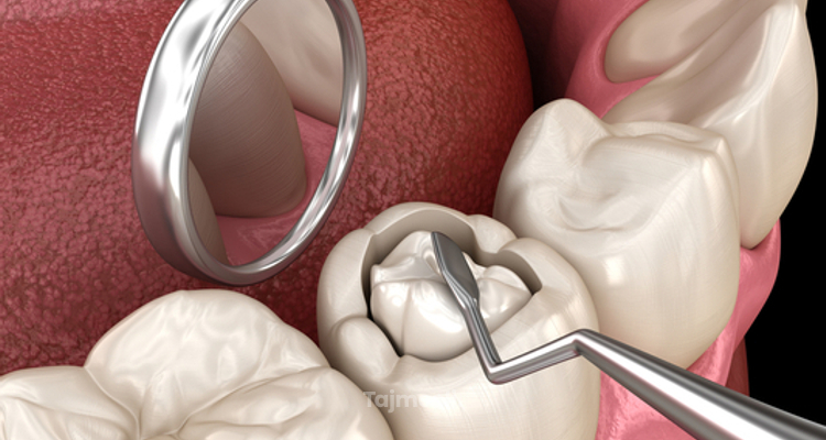 علاج الفراغات بين الأسنان السفلي