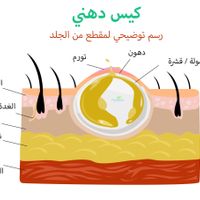 علاج الكيس الدهني في العين