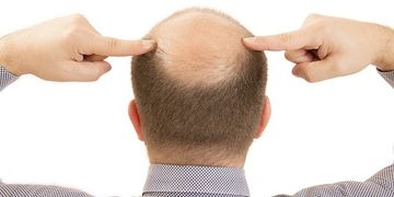 علاج تساقط الشعر للرجال الوراثي