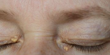 علاج رواسب الكولسترول حول العين