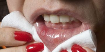 علاج فطريات اللثه والفم